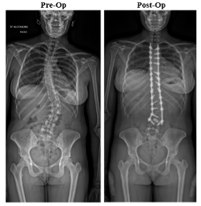 Coronal Imbalance