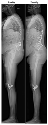 Flat Back Syndrome