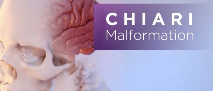 Chiari Symptoms, Causes Treatment