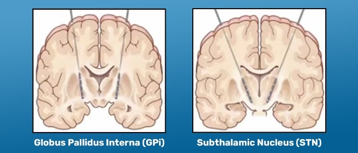 Learn about deep brain stimulation