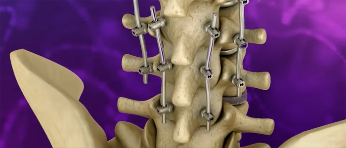 Novel Class of Spinal Fusion Implants