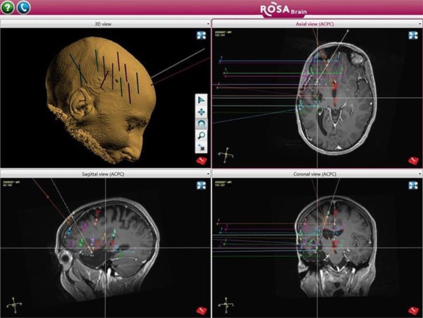 Stereoelectroencephalography (SEEG), Neurological Surgery