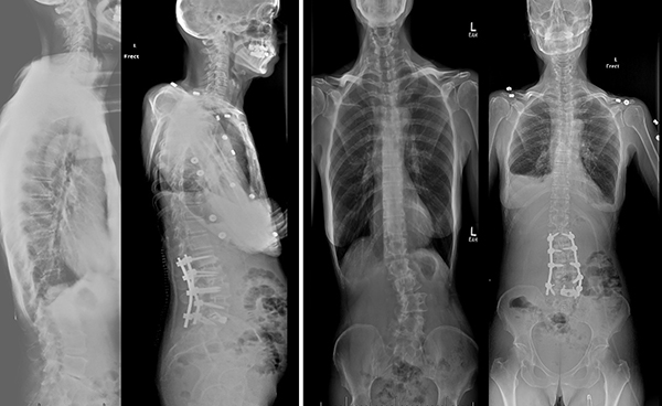 Scoliosis Example Images