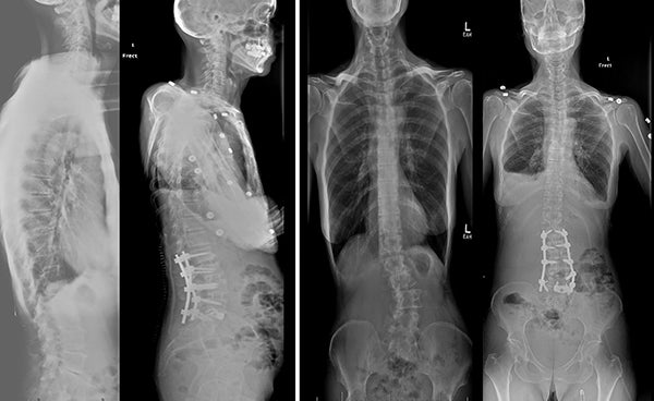 Scoliosis Example Images