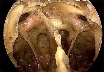 Endoscopic view of the skull base