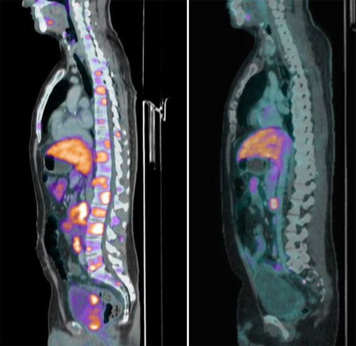 PET/CT Scans 