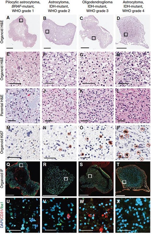 Gliomas across the malignancy continuum 