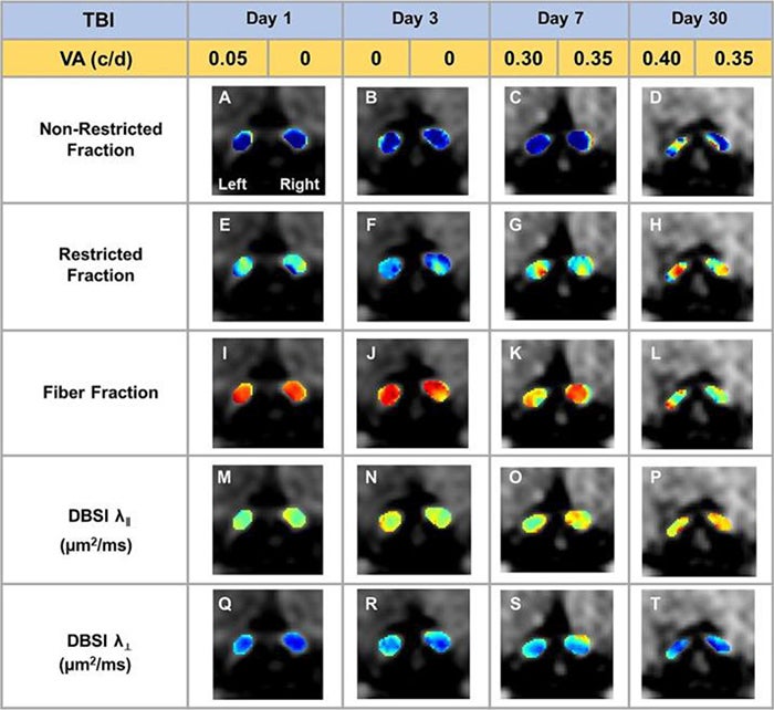 Diffusion basis spectrum imaging 