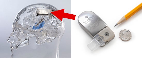 Neurostimulator implant