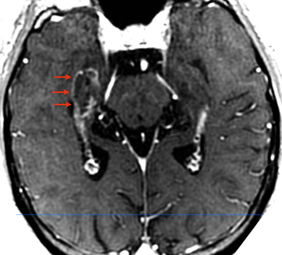 Postoperative MRI image demonstrating selective ablation of the hippocampus.