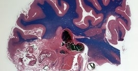 Neurosurgical Oncology Program