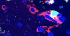 Brain Tumor Evolution