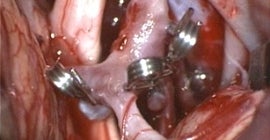 Cerebrovascular Neurosurgery