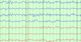 Clinical Neurophysiology Lab